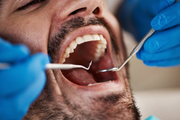 Best Emergency Dental Extractions in Camden, NJ